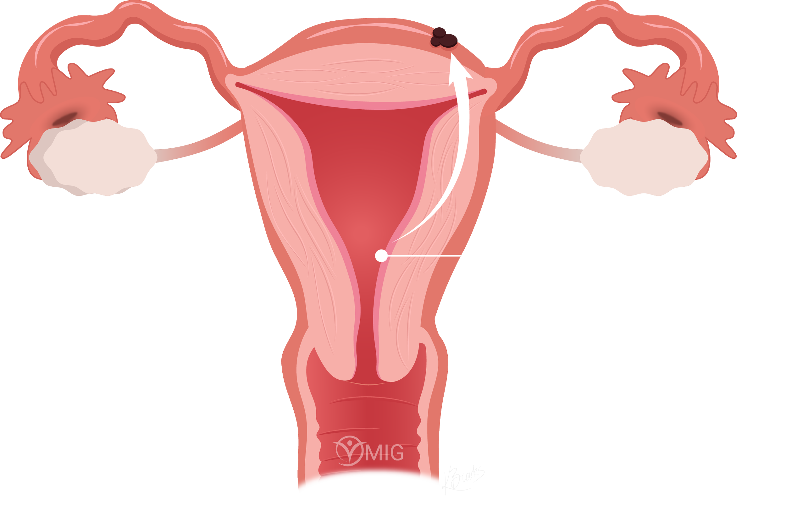 free-clip-endometriosiss-download-free-clip-endometriosiss-png-images