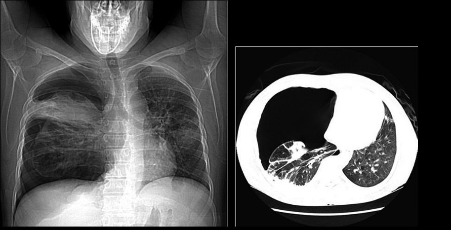 Pneumocystis Pneumonia | Encyclopedia MDPI - Clip Art Library