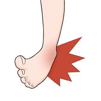 Sprain Ankle: Over 1,507 Royalty-Free Licensable Stock ... - Clip Art ...