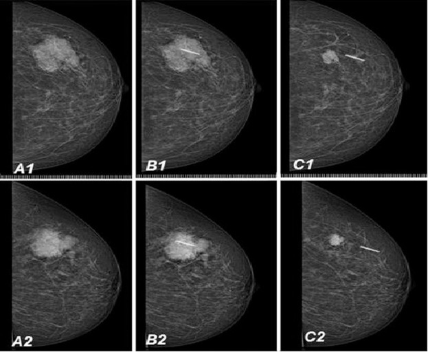 Cost-effectiveness of ultrasound-guided surgical clips placement ...